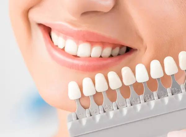 Veneers Financing, Without the Guesswork