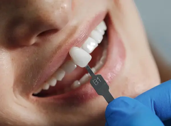 What Is a Dental Veneer?