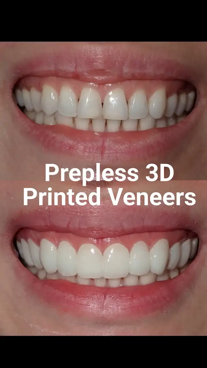 Watch the Smile Design Process